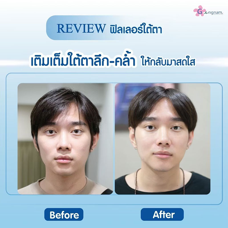 ฉีดฟิลเลอร์ แก้ถุงใต้ตา