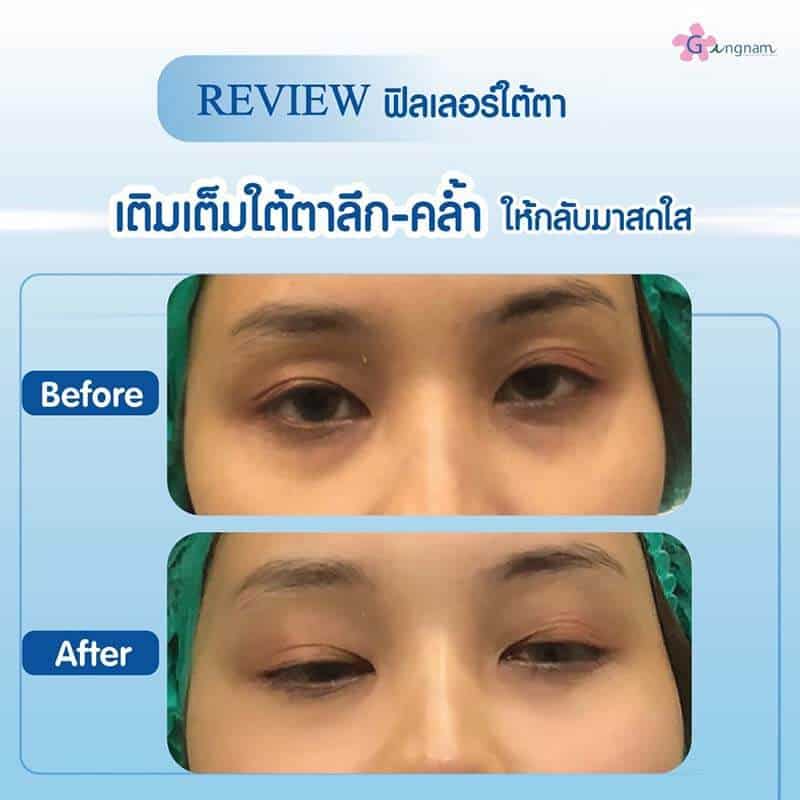 รีวิวฉีดฟิลเลอร์ใต้ตา-ตาคล้ำ