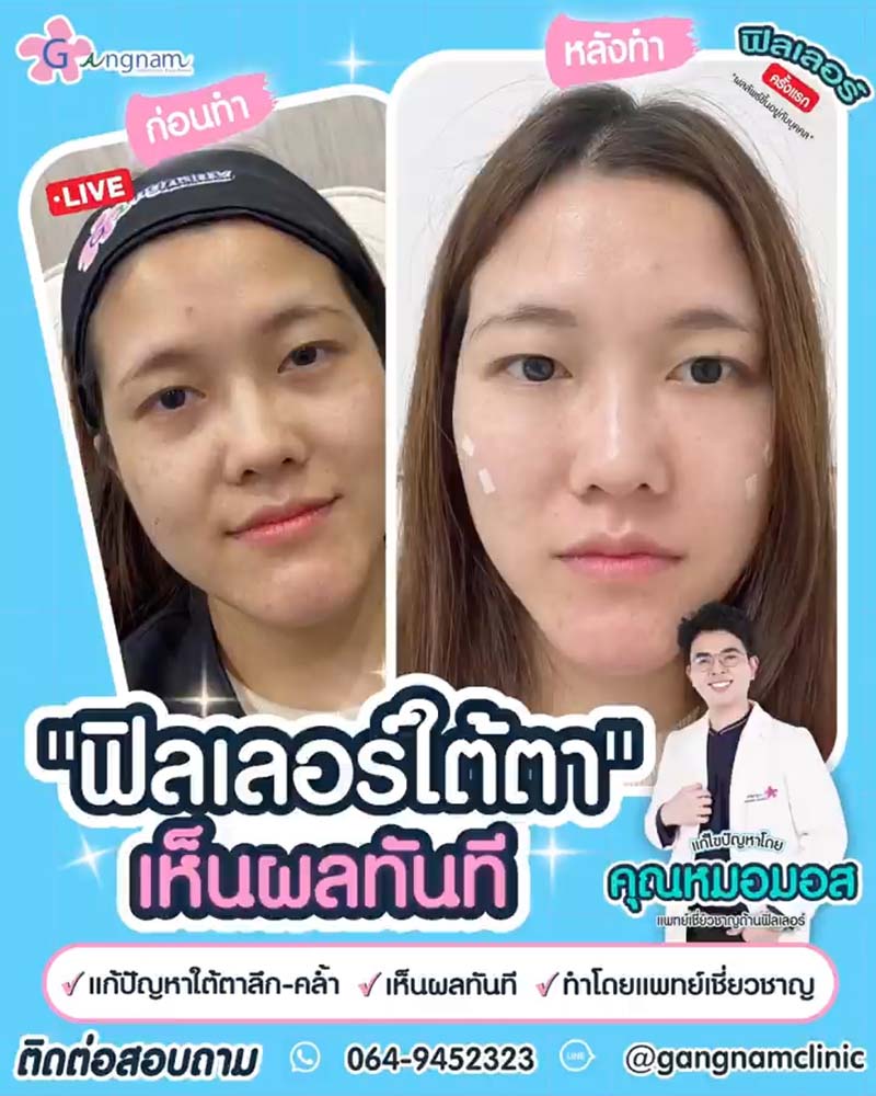 รีวิว ฟิลเลอร์ใต้ตา แก้ปัญหาใต้ตาลึกและคล้ำ