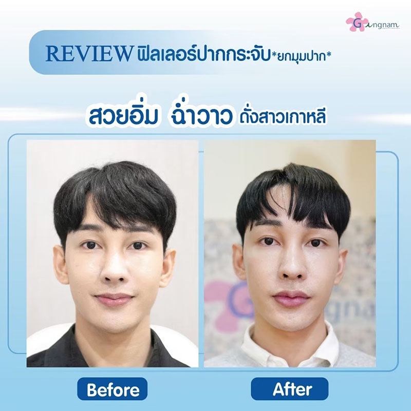 ฉีดฟิลเลอร์ปาก แบบยกมุมปาก