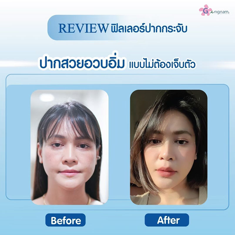 ฉีดฟิลเลอร์ปาก ให้อวบอิ่ม