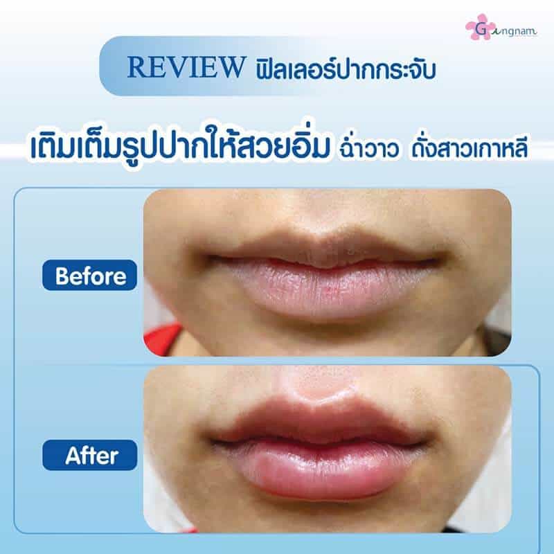 ปากคว่ำ มุมปากตก ส่งผลต่อโหงวเฮ้ง? อยากหน้าหวานละมุน แก้ด้วยวิธีไหนดี ปากคว่ำ มุมปากตก ส่งผลต่อโหงวเฮ้ง? อยากหน้าหวานละมุน แก้ด้วยวิธีไหนดี
