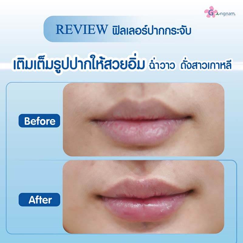 รีวิวฉีดฟิลเลอร์ปาก ให้อวบอิ่ม
