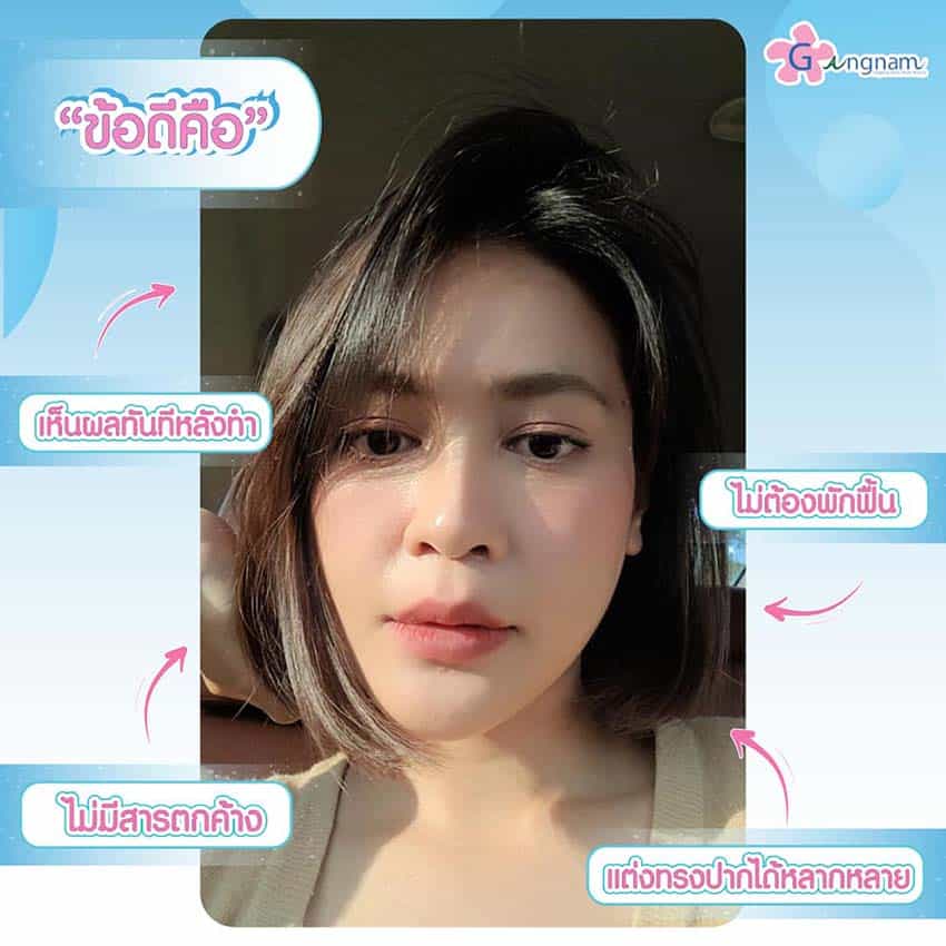 ข้อดีของการฉีดฟิลเลอร์ปาก