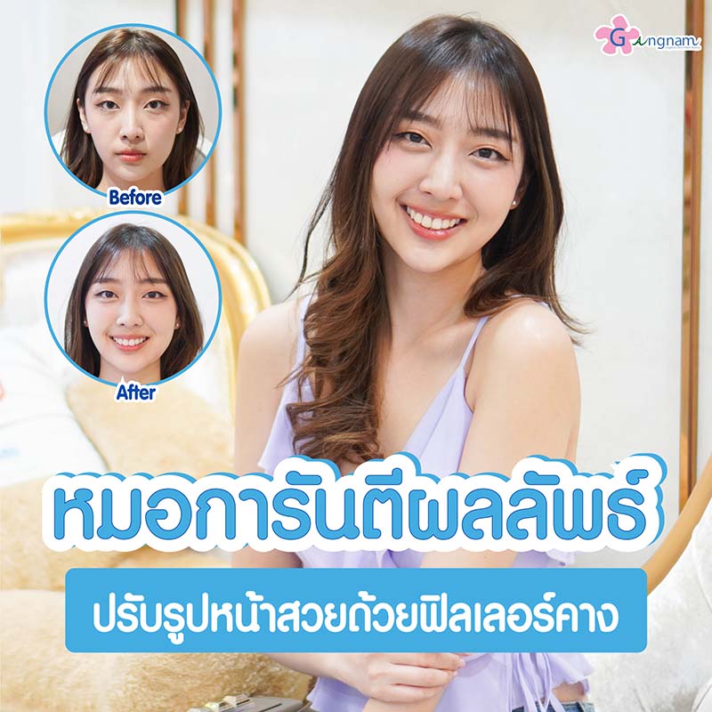 รีวิว ฟิลเลอร์คาง แก้ปัญหาคางสั้น