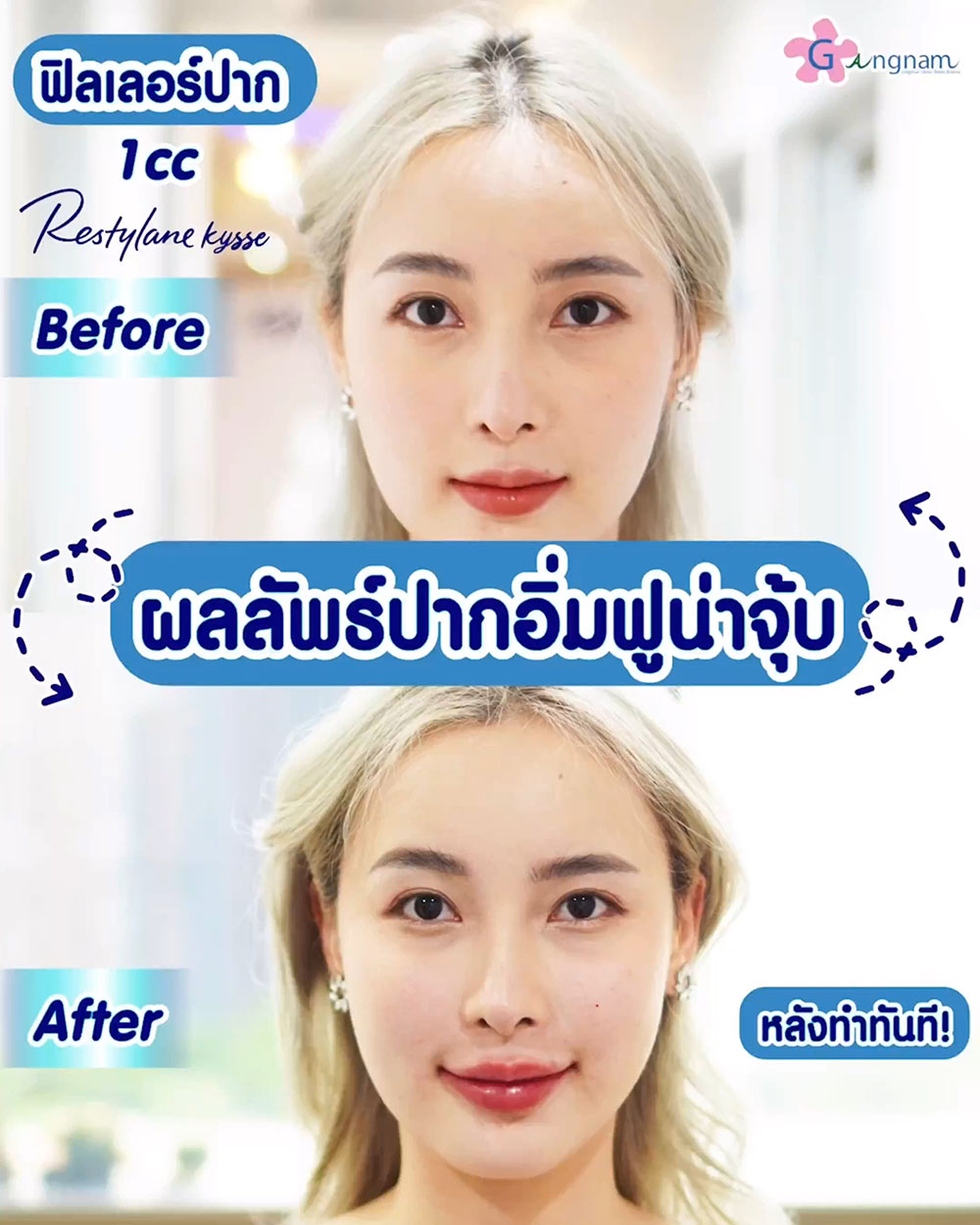 รีวิว ฟิลเลอร์ปาก 1CC ให้ปากอิ่มฟู