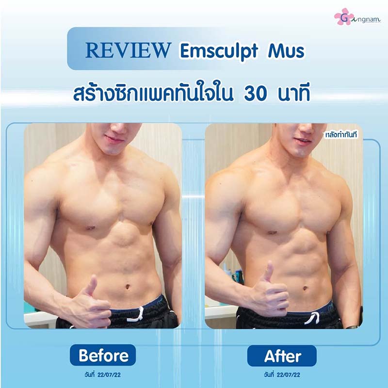 รีวิวสร้างซิกแพคด้วย Emsculpt mus