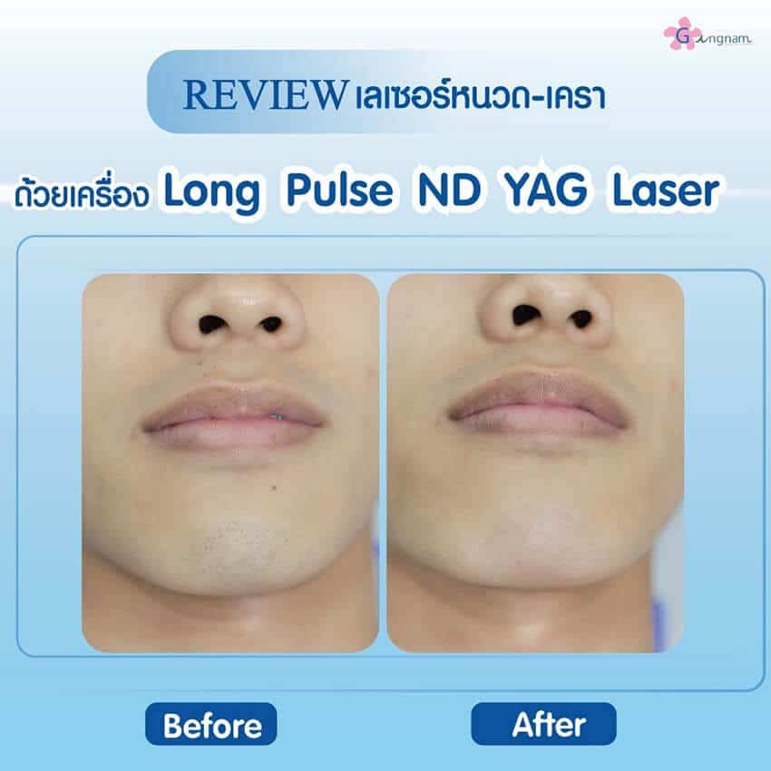 รีวิวหลังเลเซอร์หนวด และเครา