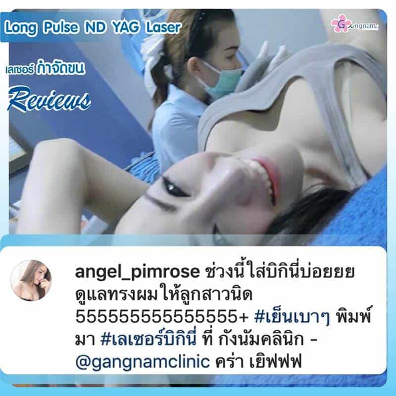รีวิวเลเซอร์ขนขอบบิกินี่