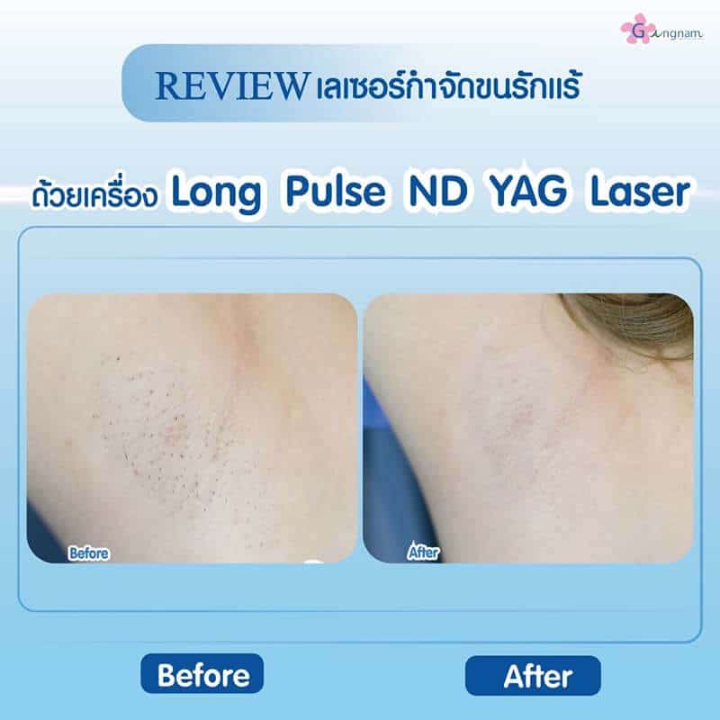 รวมข้อควรรู้ก่อนเลเซอร์ขนรักแร้ครั้งแรก แบบไหนดี ได้ผลถาวรไหม พร้อมรีวิว รวมข้อควรรู้ก่อนเลเซอร์ขนรักแร้ครั้งแรก แบบไหนดี ได้ผลถาวรไหม พร้อมรีวิว