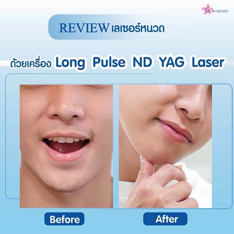 รีวิวเลเซอร์ขน กังนัม 11