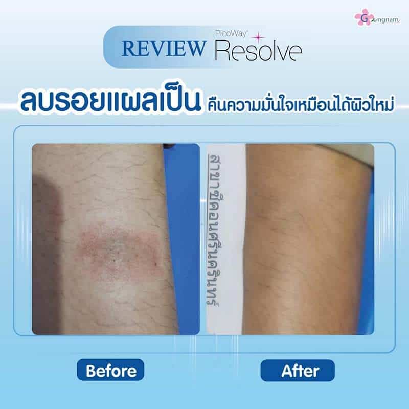รีวิวเลเซอร์รอยแผลเป็น รอยท่อไอเสีย