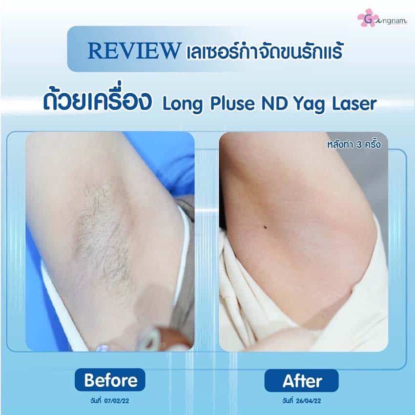 รวมข้อควรรู้ก่อนเลเซอร์ขนรักแร้ครั้งแรก แบบไหนดี ได้ผลถาวรไหม พร้อมรีวิว รวมข้อควรรู้ก่อนเลเซอร์ขนรักแร้ครั้งแรก แบบไหนดี ได้ผลถาวรไหม พร้อมรีวิว