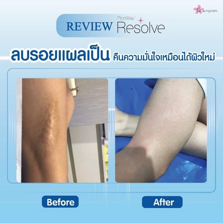รีวิวเลเซอร์ลบรอยแผลเป็นนูน คีลอยด์