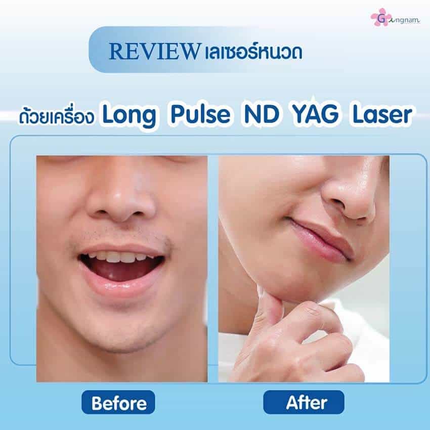 รีวิวเลเซอร์หนวด ผู้ชาย