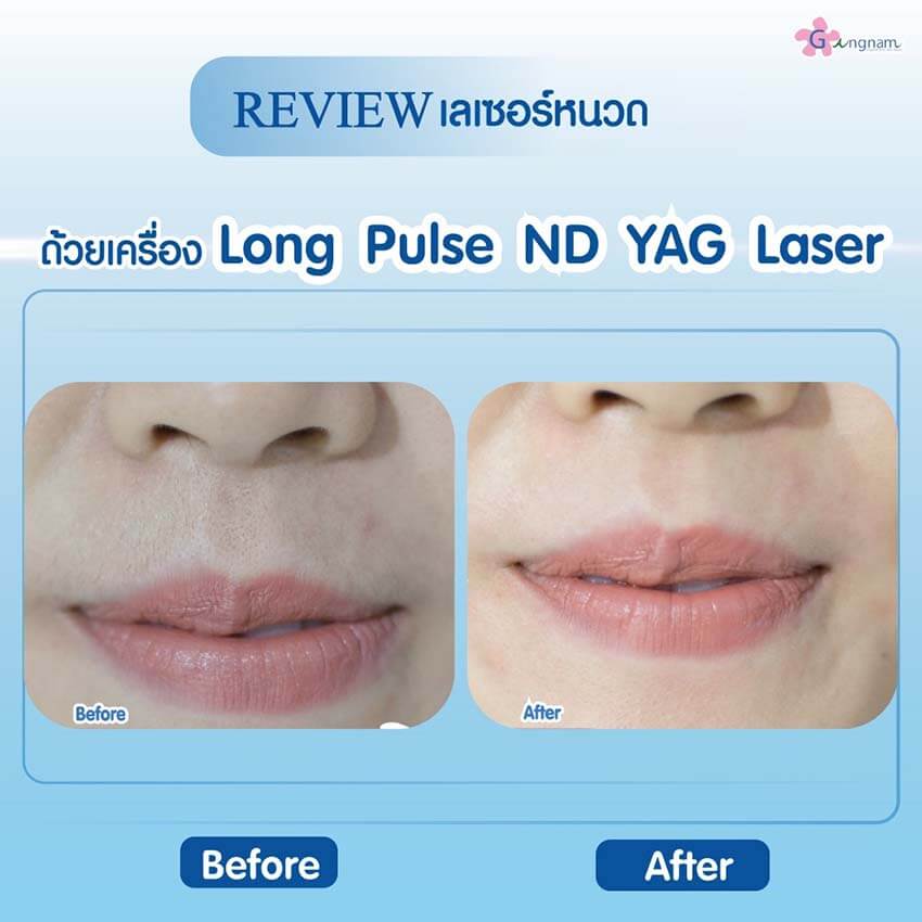 รีวิวเลเซอร์หนวด ผู้หญิง