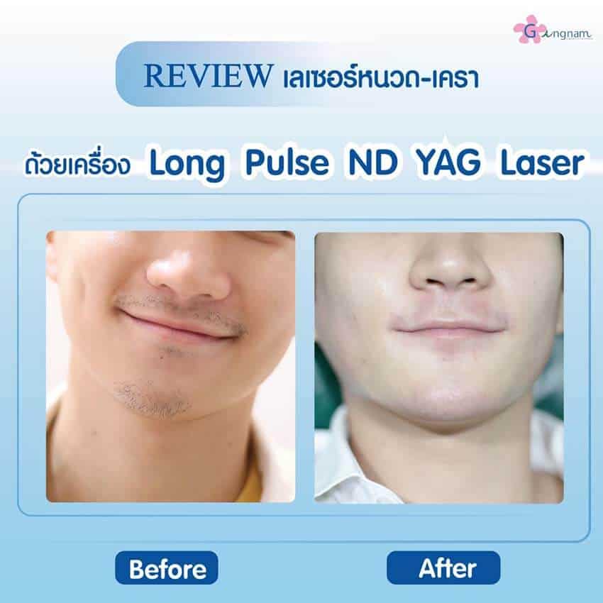 เลเซอร์หนวด กำจัดหนวดถาวร ราคาเท่าไหร่? ที่ไหนดี? เห็นผลจริงไหม - Gangnam Clinic เลเซอร์หนวด กำจัดหนวดถาวร ราคาเท่าไหร่? ที่ไหนดี? เห็นผลจริงไหม - Gangnam Clinic