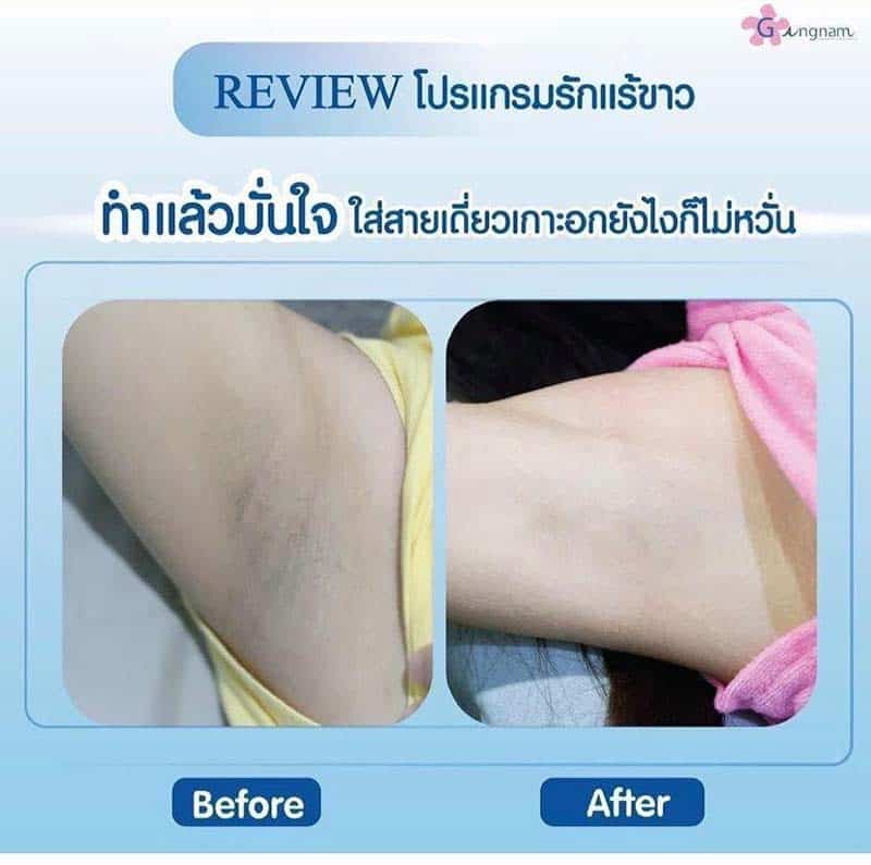 เลเซอร์รักแร้ขาว - Gangnam Clinic เลเซอร์รักแร้ขาว - Gangnam Clinic
