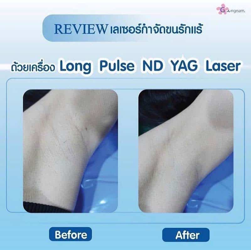 เลเซอร์รักแร้ขาว - Gangnam Clinic เลเซอร์รักแร้ขาว - Gangnam Clinic