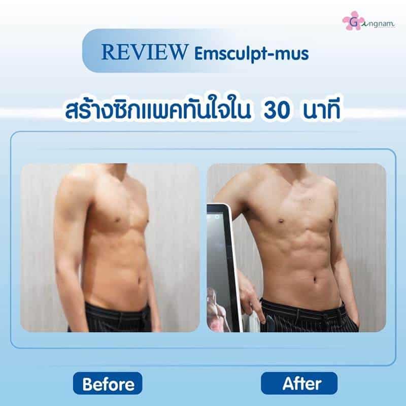 รีวิว Emsculpt-mus สร้างซิกแพคผู้ชาย