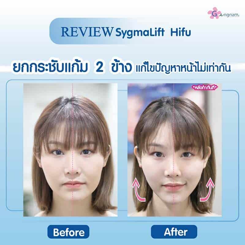 รีวิว Sygmalift Hifu กรอบหน้า