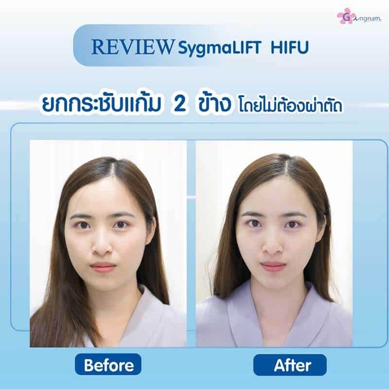 รีวิว Sygmalift Hifu ยกกระชับกรอบหน้า