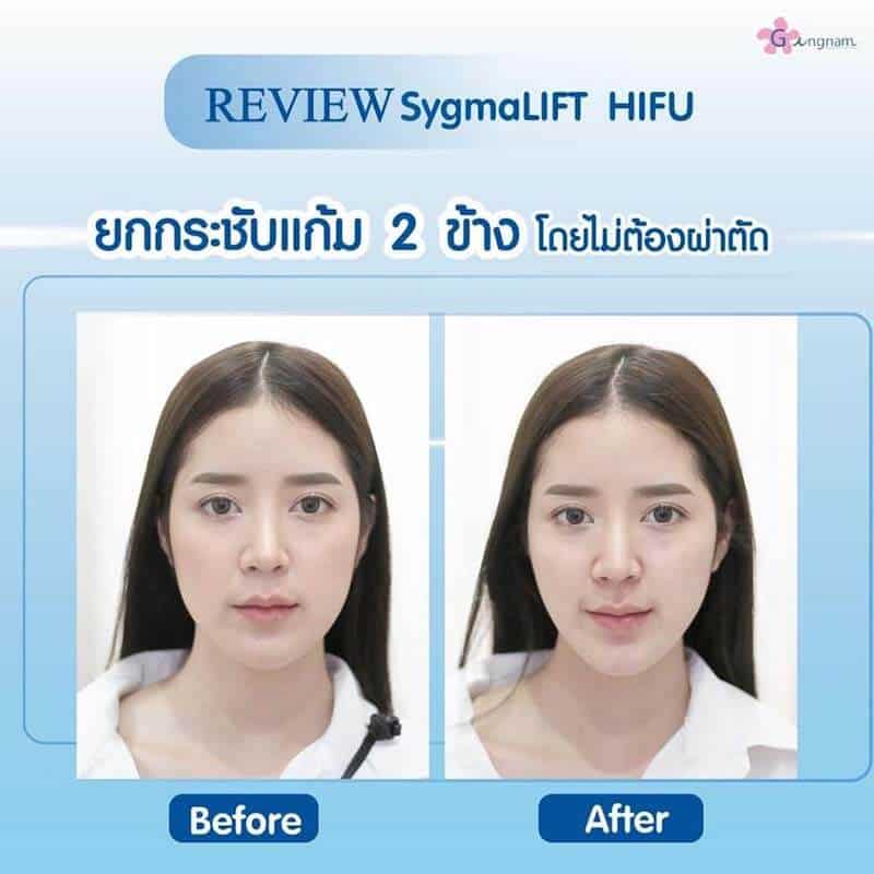 รีวิว Sygmalift Hifu ยกกระชับหน้าหย่อนคล้อย