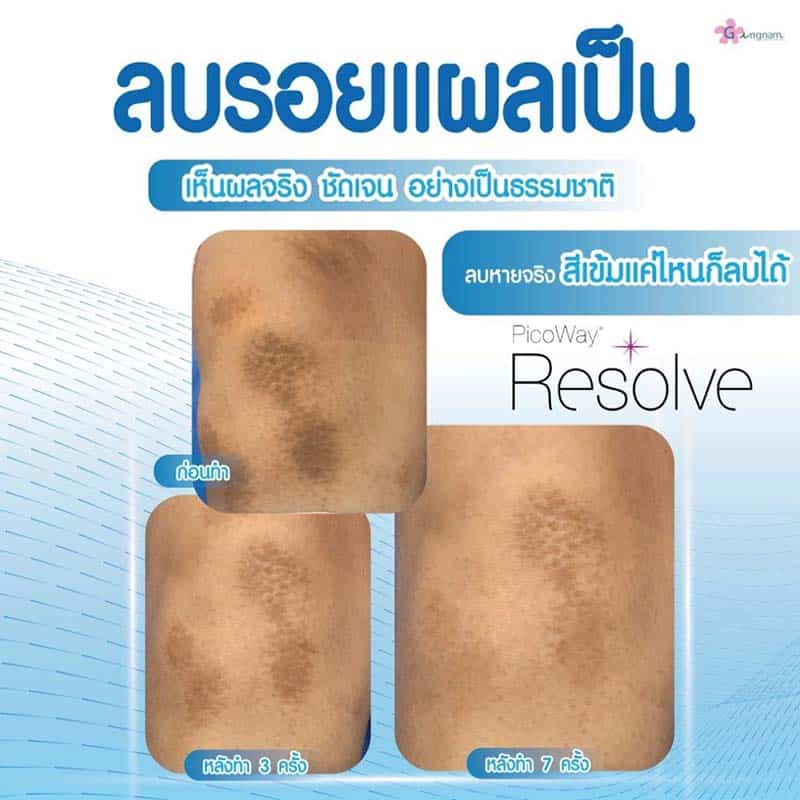 ลบรอยแผลเป็น เหมาะกับใครบ้าง
