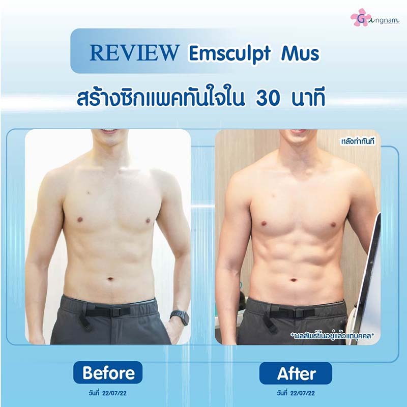 หลังทำ Emsculpt mus ซิกแพคหน้าท้องชัด