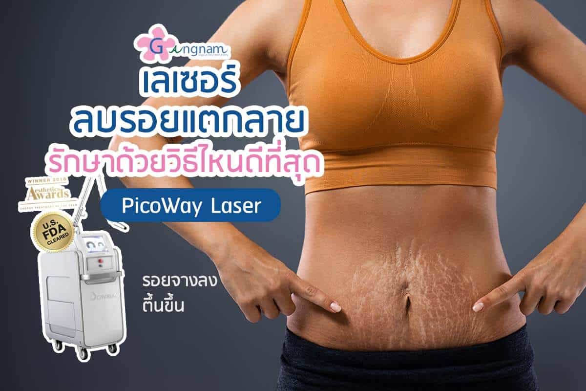 เลเซอร์รอยแตกลาย - Gangnam Clinic เลเซอร์รอยแตกลาย - Gangnam Clinic