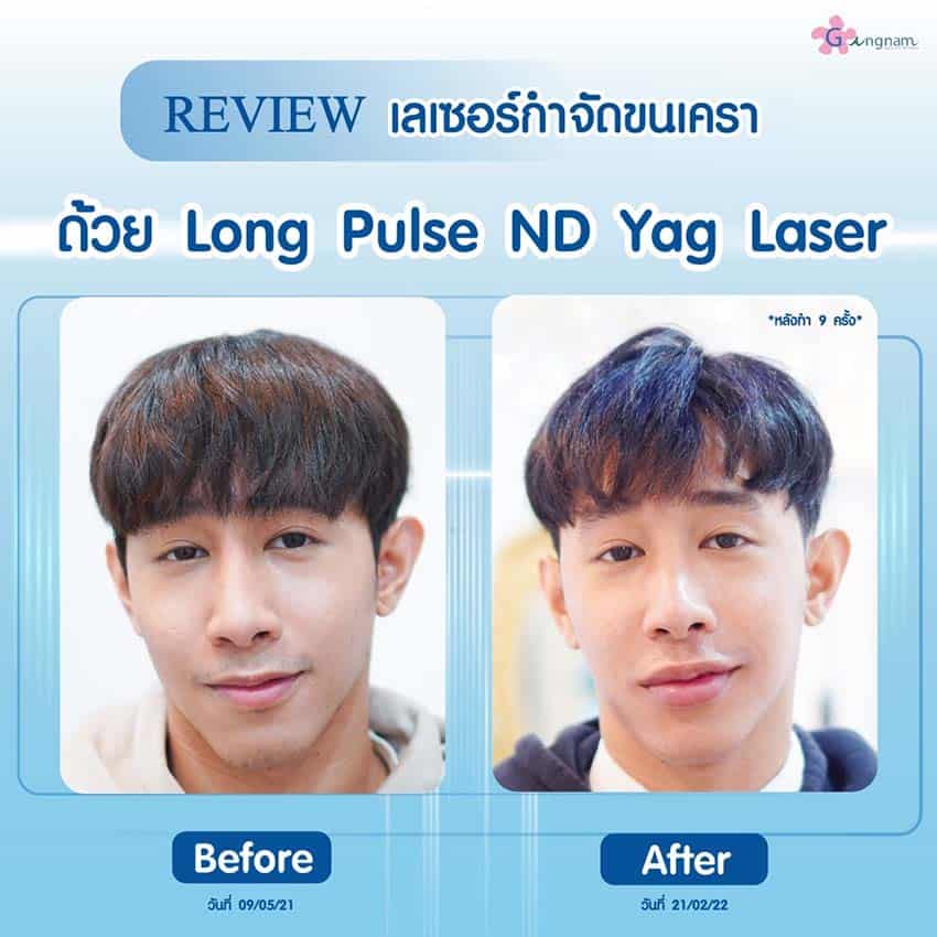 เลเซอร์หนวด รีวิว