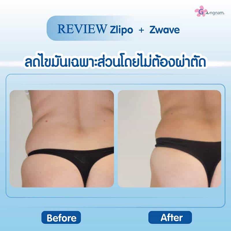 Review Zlipo Zwave สลายไขมัน