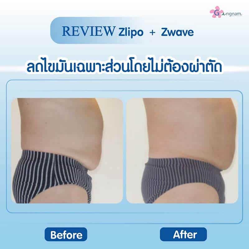 Review Zlipo Zwave สลายไขมันหน้าท้อง