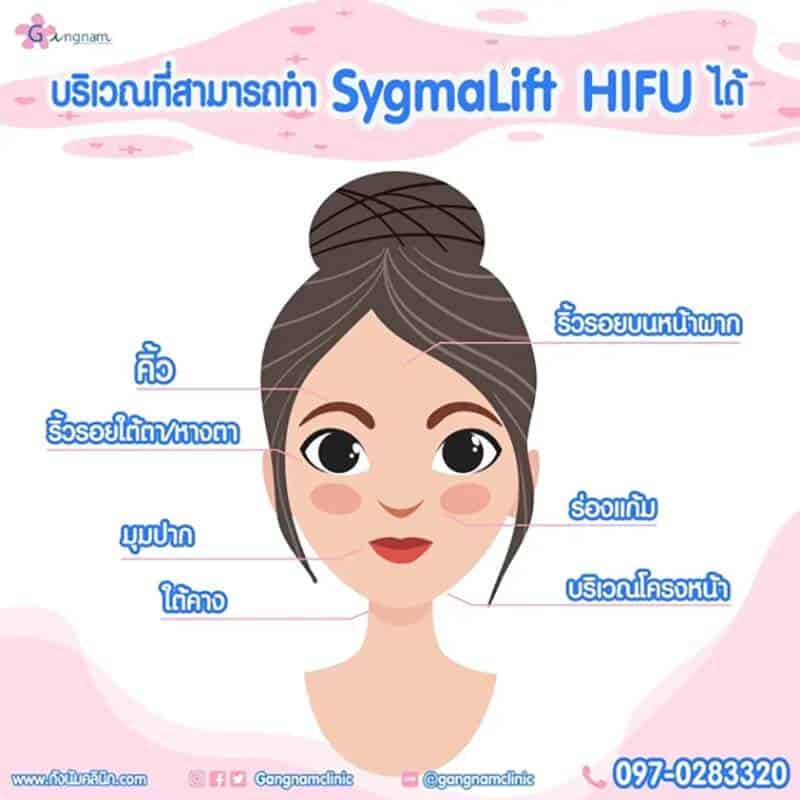 Sygmalift-Hifu-จุดไหนดี