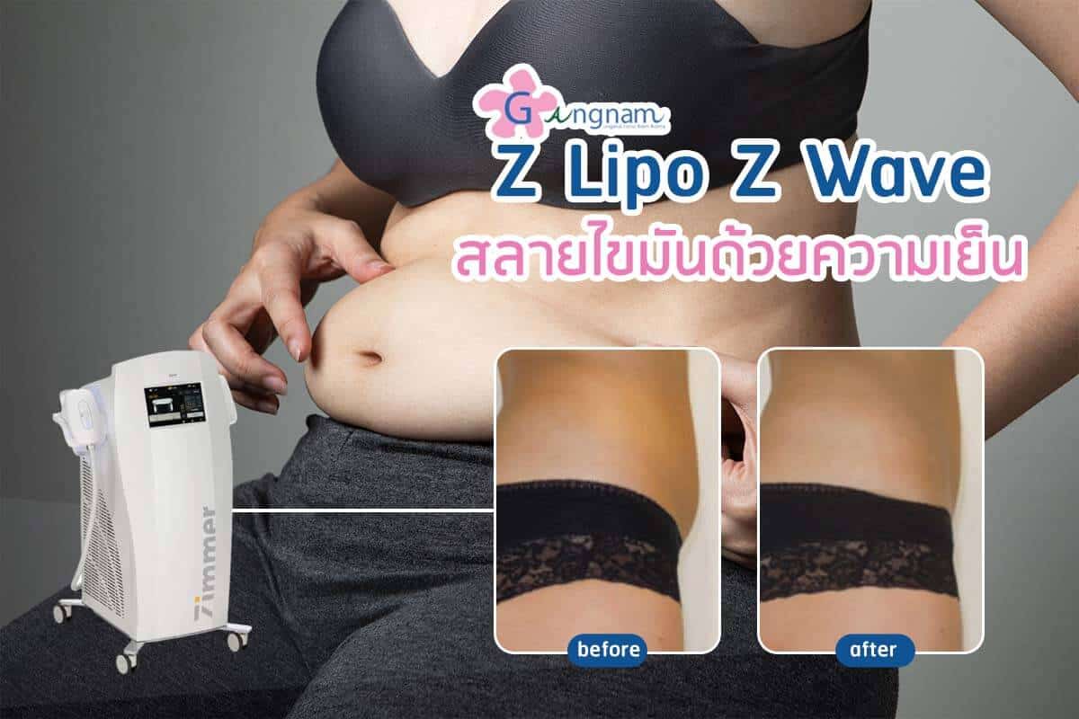 Z Wave Z Lipo สลายไขมันส่วนเกินด้วยความเย็น