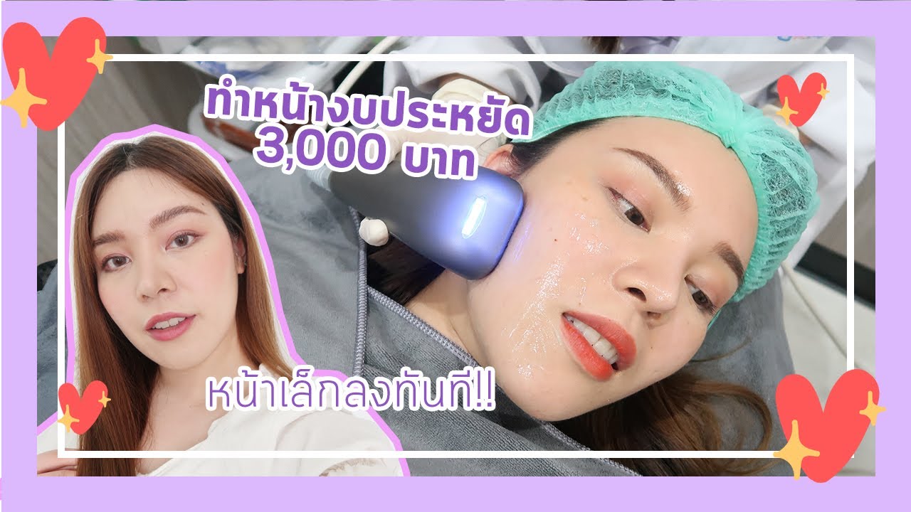 vdo รีวิว sygmalift hifu ยกกระชับหน้าเรียว