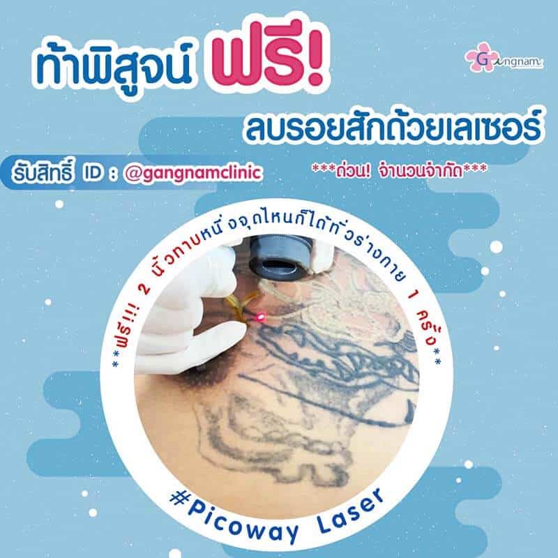 ฟรีลบรอยสักด้วยเลเซอร์ ขนาด 2 นิ้วทาบ