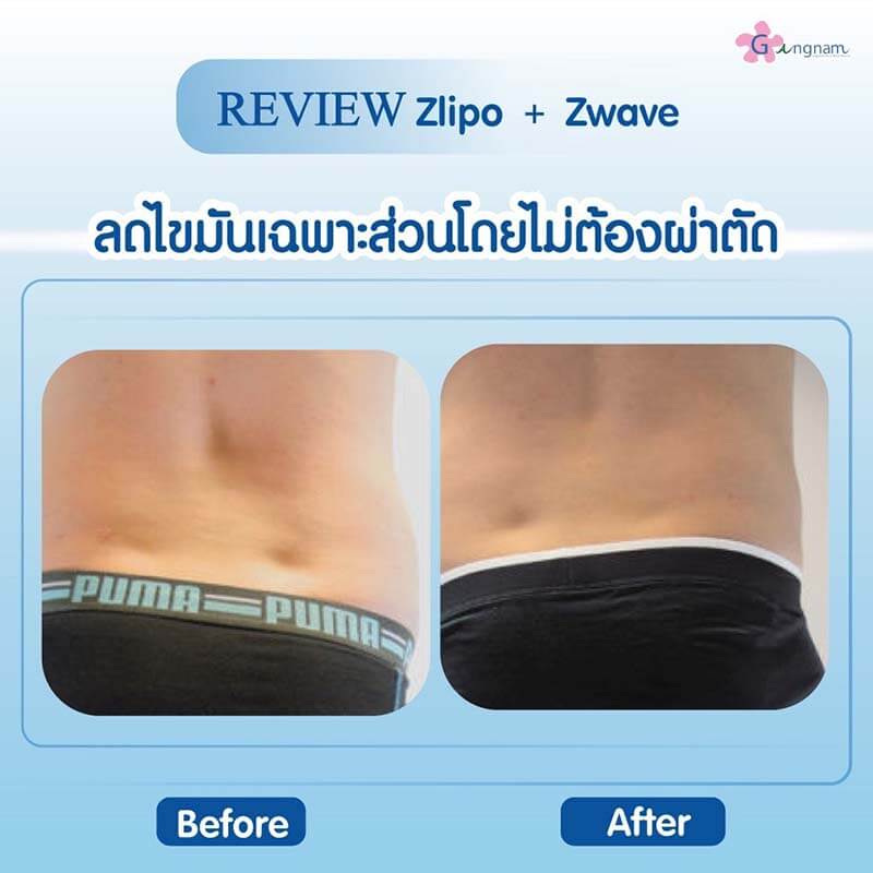 รีวิว Zwave Zlipo ลดไขมันสะโพก