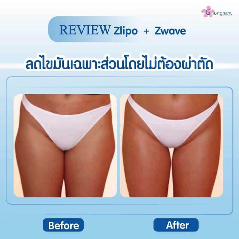 รีวิว Zwave Zlipo สลายไขมันต้นขา