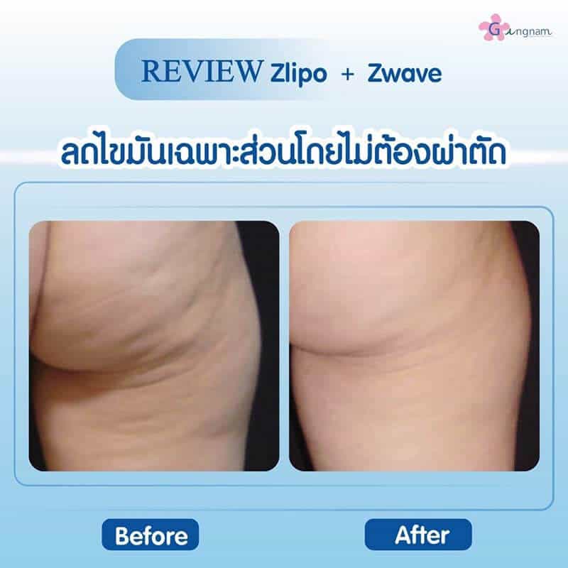 รีวิว Zwave Zlipo สลายไขมันไม่ต้องผ่าตัด