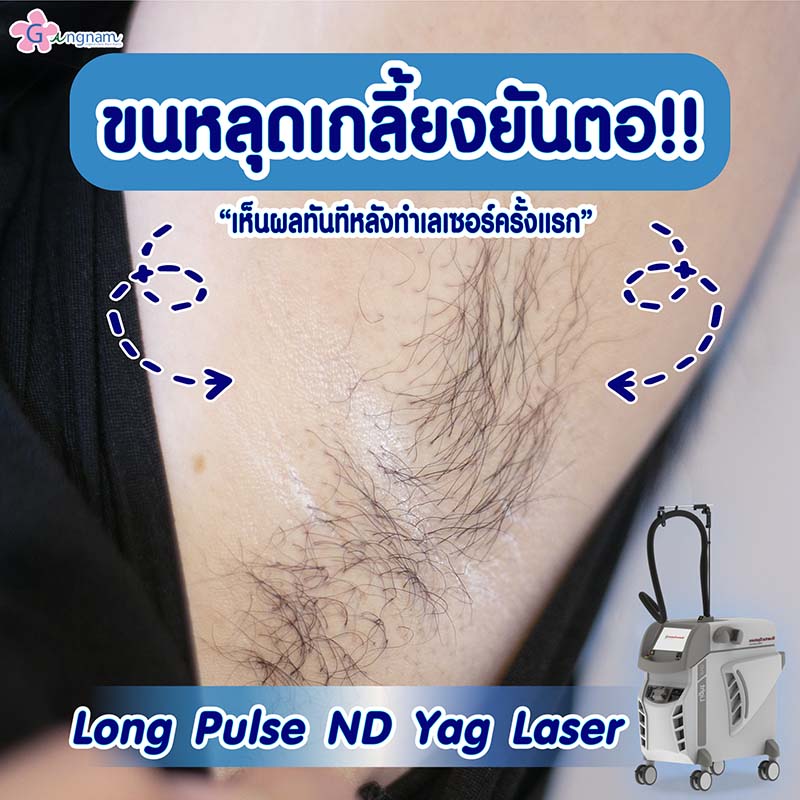 รีวิว เลเซอร์รักแร้ แก้ปัญหาผิวไม่เรียบเนียน ขนเป็นตอ