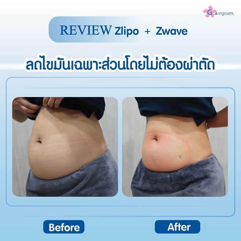 รีวิวลดไขมันเฉพาะส่วน Zwave Zlipo