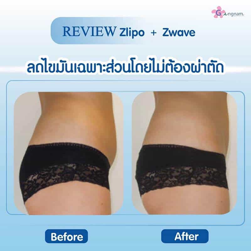 รีวิวสลายไขมันหน้าท้องผู้หญิง