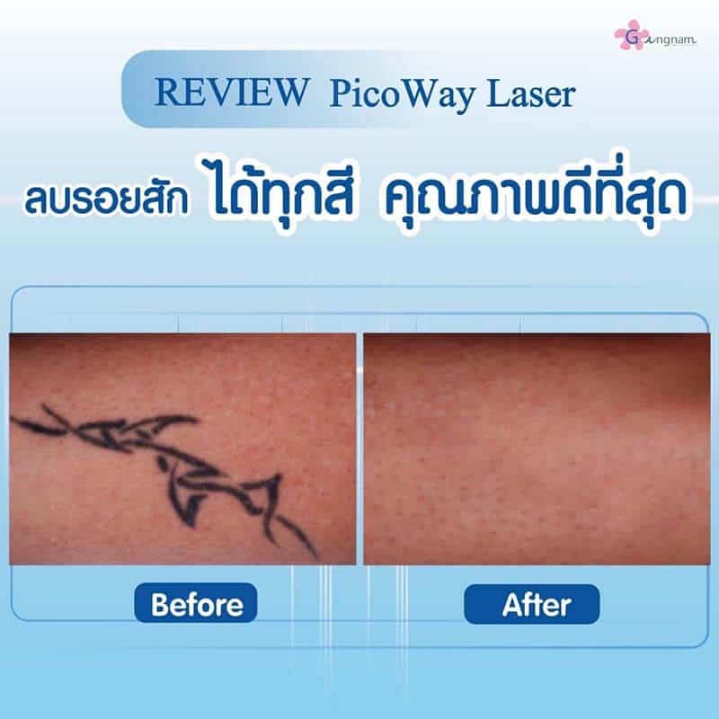 รีวิวเครื่อง Pico way ลบรอยสัก