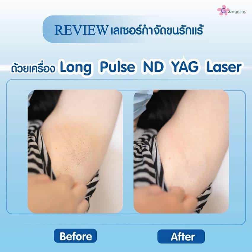 รีวิวเลเซอร์ขนรักแร้-nd-yag