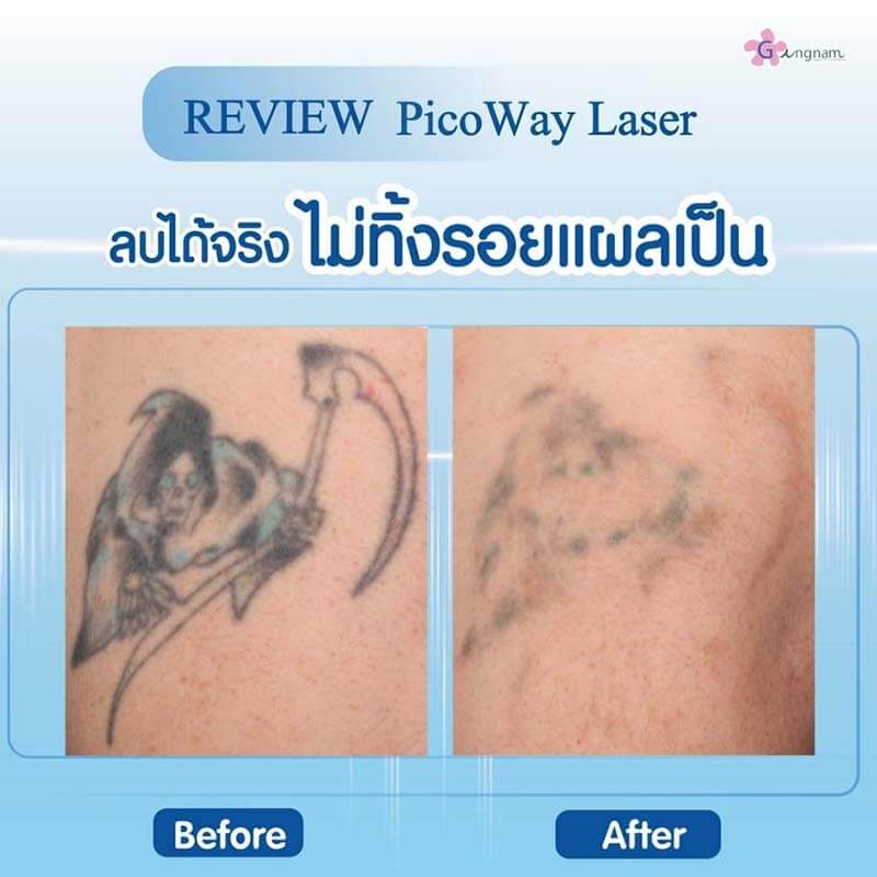 รีวิวเลเซอร์ลบรอยสัก ลบได้จริงไม่ทิ้งรอยแผลเป็