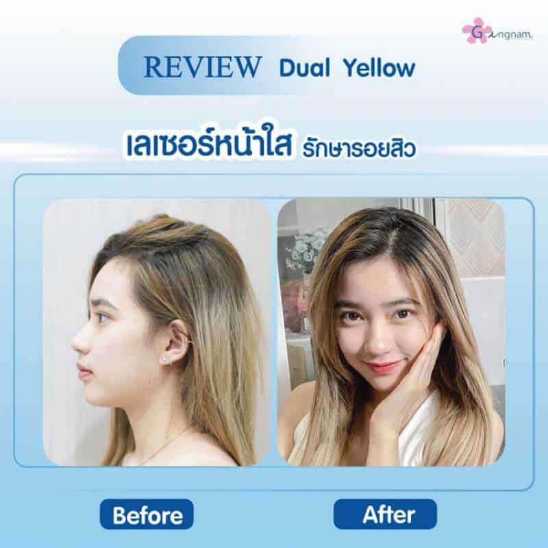 รีวิวเลเซอร์หน้าใส ฟื้นฟูสภาพผิว