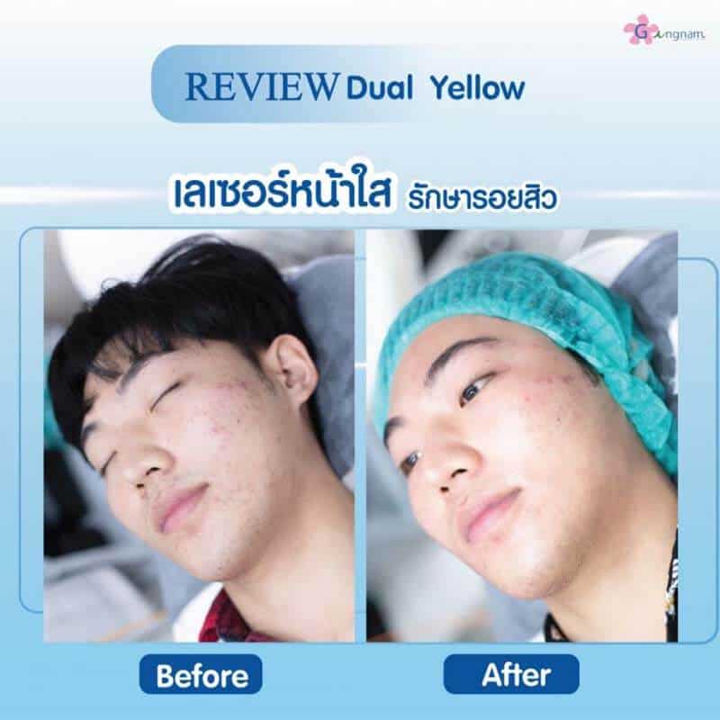 รีวิวเลเซอร์หน้าใส รักษารอยสิว