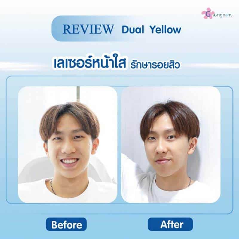 รีวิวเลเซอร์หน้าใส รักษารอยสิวผู้ชาย