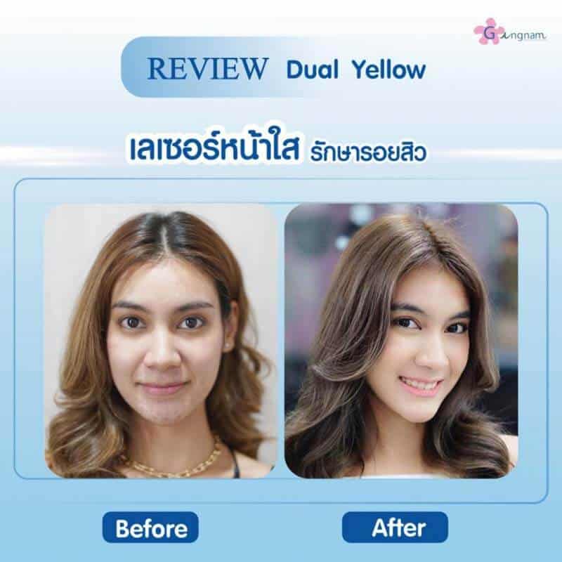 รีวิวเลเซอร์หน้าใส ลดฝ้าและกระ